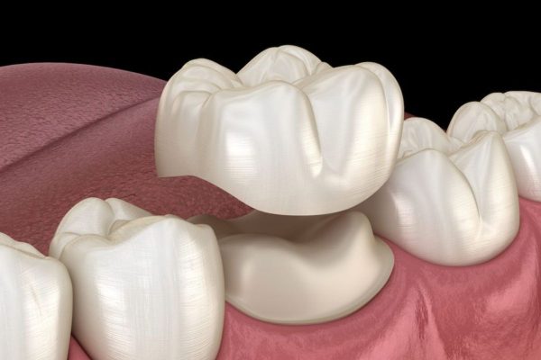 Bọc răng sứ là kỹ thuật gắn mão sứ lên trên cùi răng thật sau khi mài để phục hình