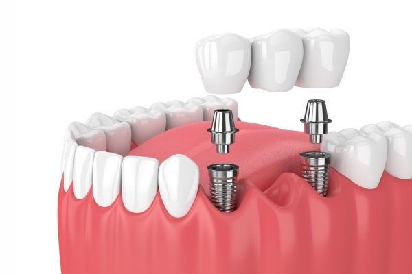 Trụ Imlant có vai trò như những chiếc chân răng thật, giúp cố định mão sứ và tạo nên kết cấu răng chắc chắn vượt trội