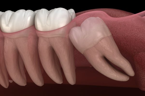 Răng số 8 mọc lệch, mọc ngầm tiềm ẩn nhiều nguy cơ biến cứng nên cần phải nhổ bỏ kịp thời