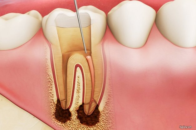 Có cần phải lấy tủy khi bọc răng sứ không?