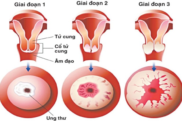 ung thư cổ tử cung