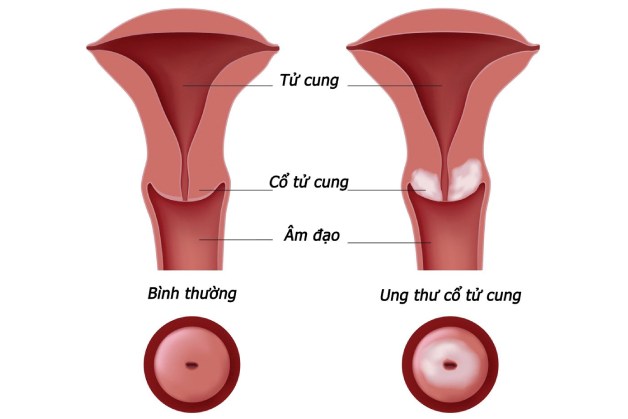 ung thư cổ tử cung là gì