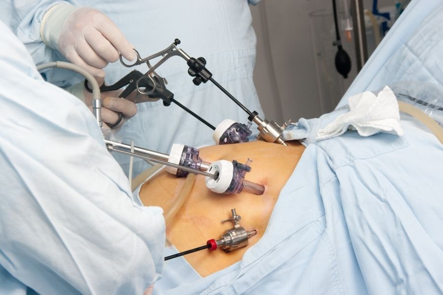 nội soi sau phúc mạc lấy sỏi niệu quản