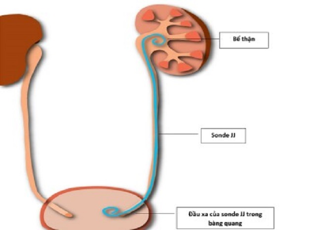 phẫu thuật nội soi sau phúc mạc lấy sỏi