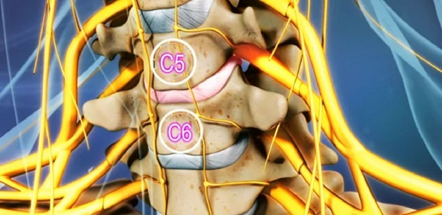 đau cột sống cổ do thoát vị đĩa đệm, thoái hóa