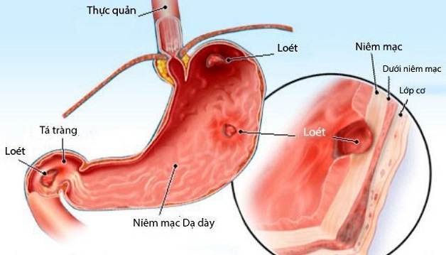 Đau dạ dày tá tràng là bệnh lý thường gặp