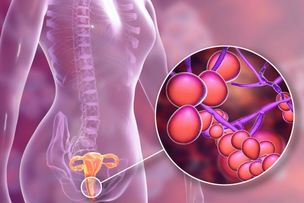 Dấu hiệu bệnh viêm âm đạo do nhiễm trùng nấm men