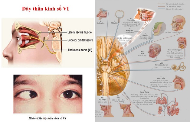 dây thần kinh sọ não số 6 