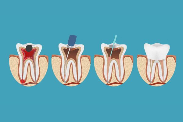 Quy trình điều trị tủy răng cần được thực hiện bởi bác sĩ có chuyên môn cao để đảm bảo an toàn