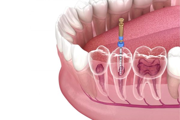 Tủy răng là tổ chức đặc biệt, liên kết mạch máu, thần kinh ở trong hốc tủy và được các mô răng bao quanh bảo vệ