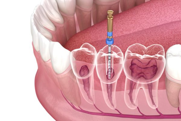 Điều trị tủy răng là gì - Là quá trình bác sĩ tiến hành loại bỏ hết phần tủy răng bị viêm nhiễm