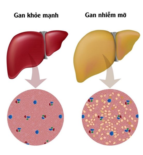Phương pháp điều trị gan nhiễm mỡ độ 3