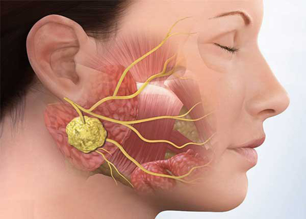 khám sinh thiết hạch ở tai