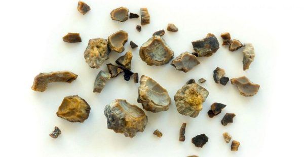 Chi phí tán sỏi nội soi ngược dòng
