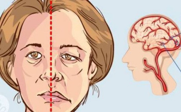 triệu chứng điển hình của bệnh nhân đột quỵ