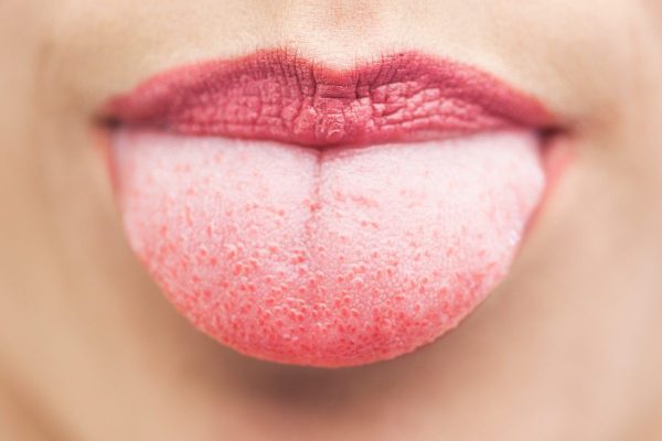 nấm miệng candida