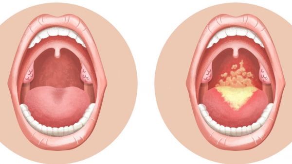 nấm miệng candida