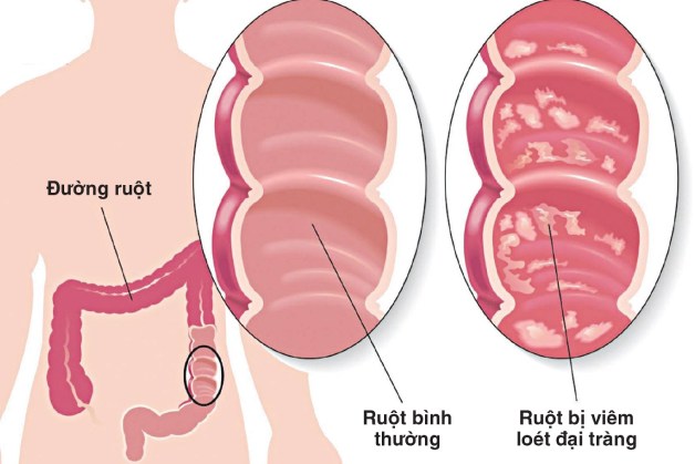 viêm loét đại tràng có biểu hiện gì