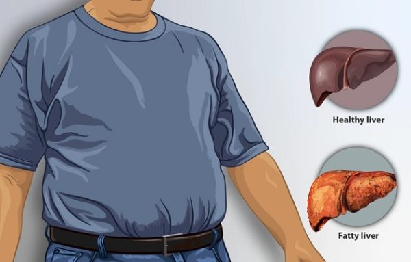 Đối tượng có nguy cơ cao mắc gan nhiễm mỡ không do rượu