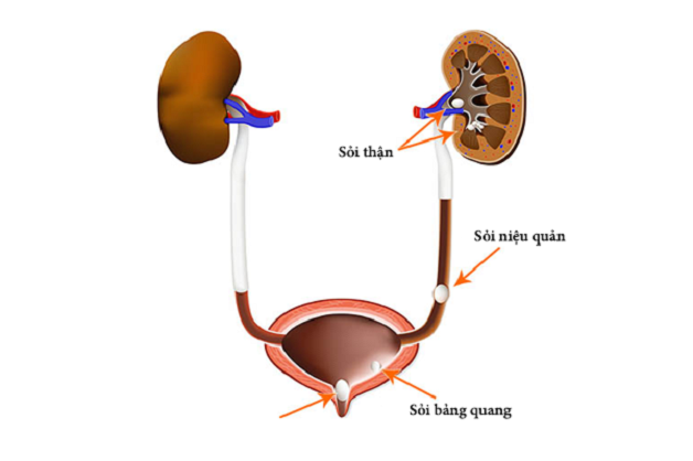 nguyên nhân gây sỏi bàng quang
