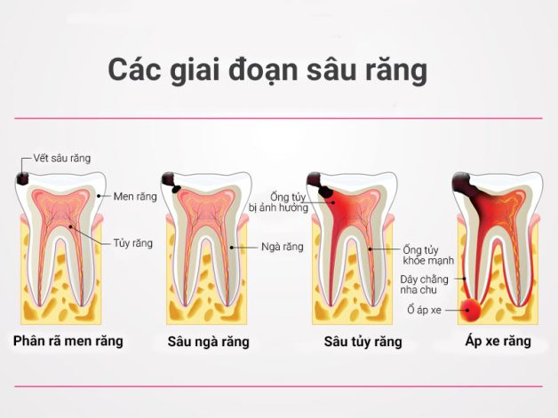 cách chữa sâu răng hiệu quả
