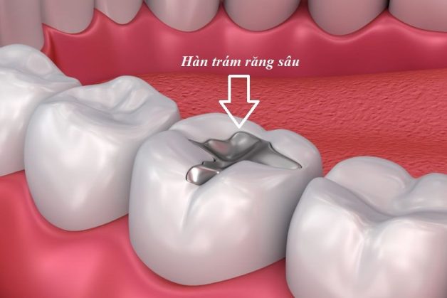 cách chữa răng sâu hiệu quả