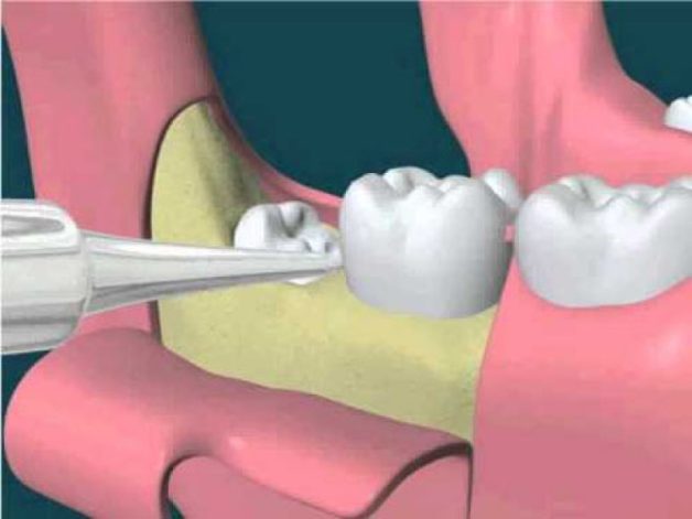 Nhổ răng 8 mọc ngầm