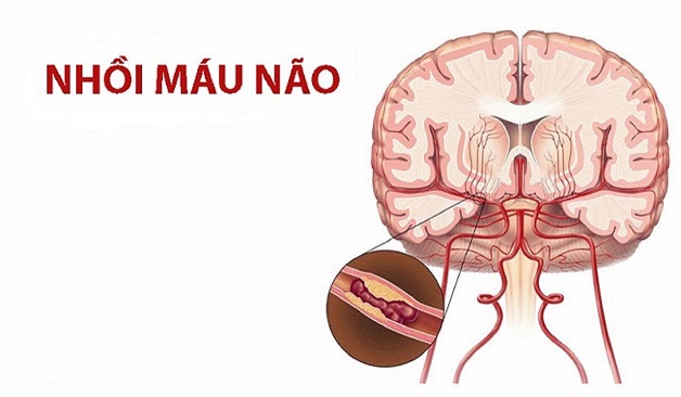 Nguyên nhân nhồi máu não thường gặp