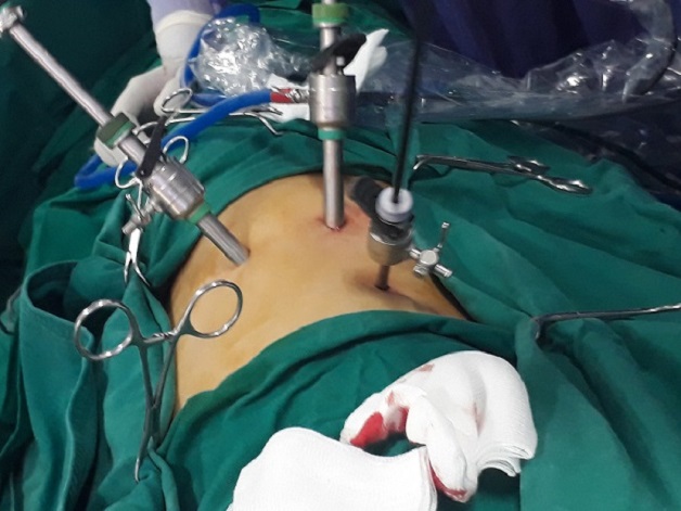 nội soi sau phúc mạc lấy sỏi niệu quản