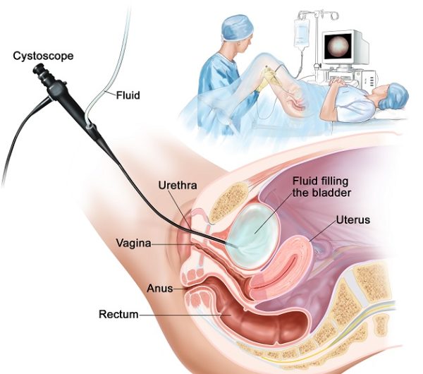 Điều trị sỏi bàng quang 5mm