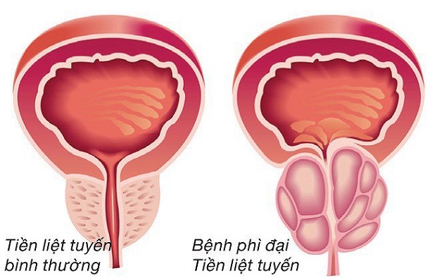 nguyên nhân gây sỏi bàng quang