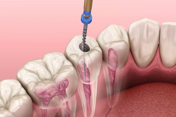 Điều trị tủy là thủ thuật bảo tồn răng bằng việc loại bỏ hết tủy răng bị viêm nhiễm, chết tủy