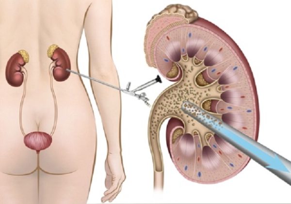 Tìm hiểu phương pháp tán sỏi ngoài cơ thể và tán sỏi qua da