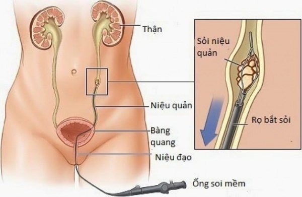 Chi phí tán sỏi niệu quản ngược dòng