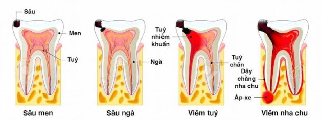 sâu răng để lâu