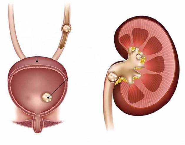 Sỏi bàng quang 10mm có nguy hiểm không và phương pháp điều trị