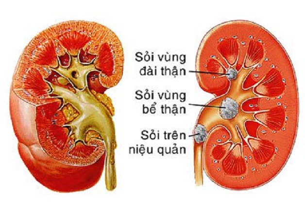 phẫu thuật nội soi sau phúc mạc lấy sỏi