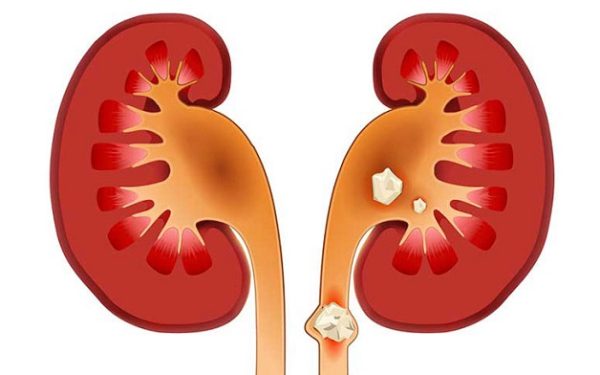 Sỏi niệu quản 5mm