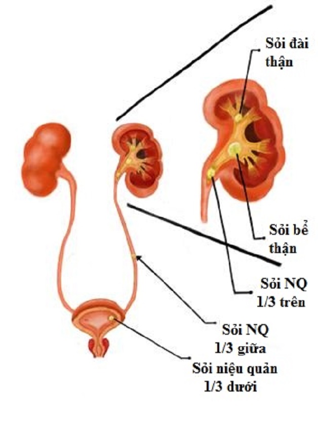 nội soi sau phúc mạc lấy sỏi niệu quản