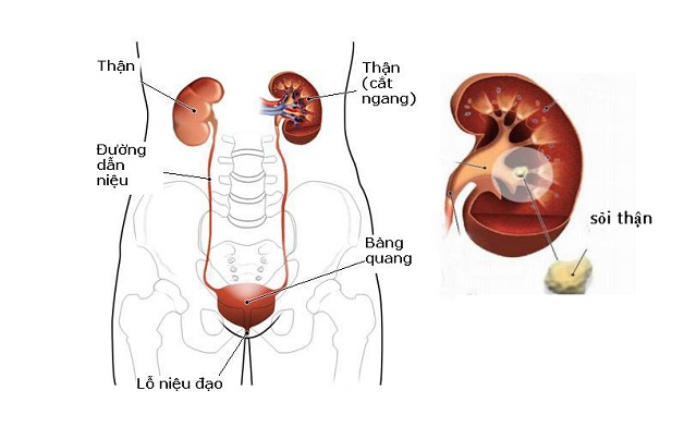 cách điều trị sỏi tiết niệu