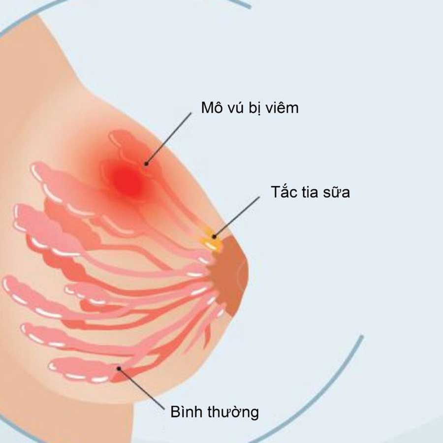 Hình ảnh tuyến vú bị viêm