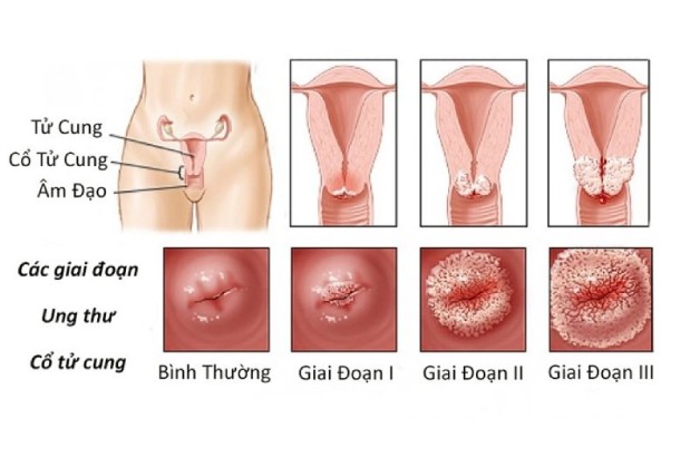 ung thư cổ tử cung là gì