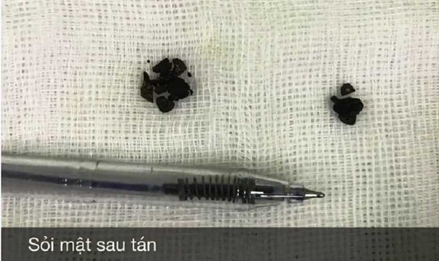 tán sỏi mật