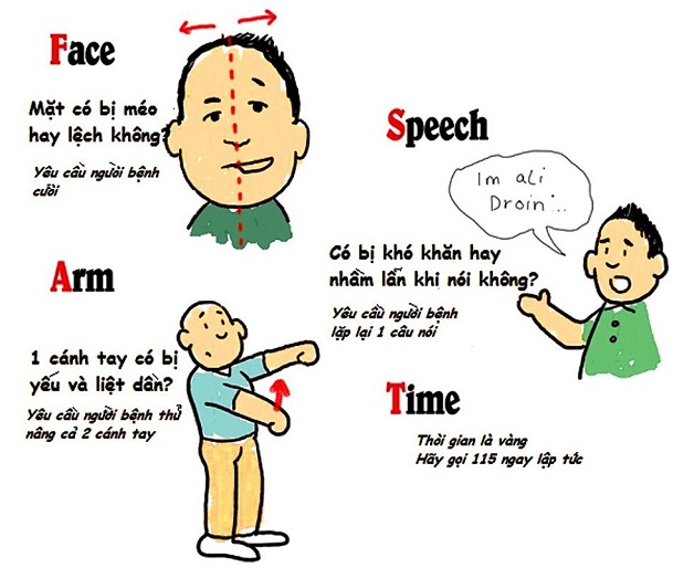 Triệu chứng của bệnh nhồi máu não
