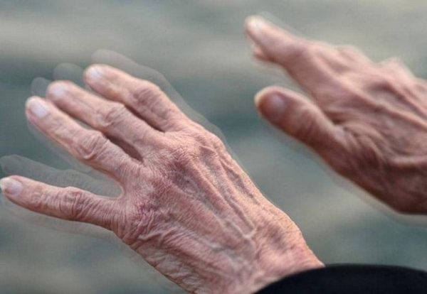 Triệu chứng bệnh Parkinson thường gặp
