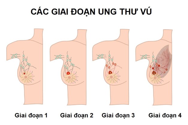 ung thư vú là gì