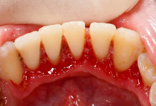 viêm cuống răng do đâu?