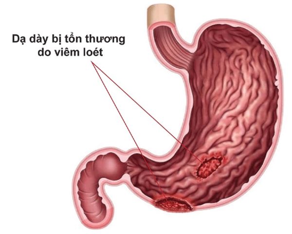Bệnh viêm loét dạ dày