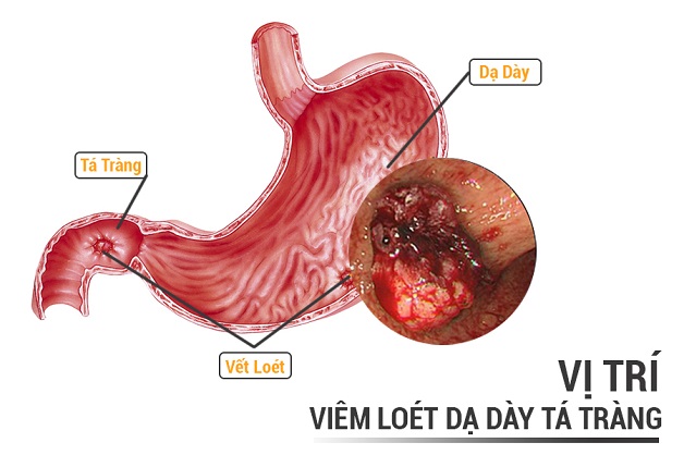 bệnh viêm tá tràng