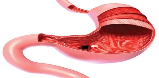 Viêm loét hang vị dạ dày là bệnh lý phổ biến ở đường tiêu hóa
